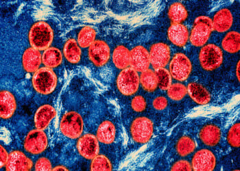 Severe Strain of Monkeypox Virus Detected in Los Angeles