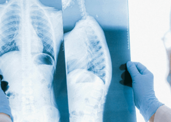 15-Year-Old Athlete Walks Out of California Hospital After Paralyzing Spinal Injury