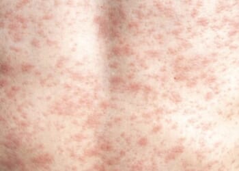 RFK Jr. Needs to 'Unconditionally' Advocate for Measles Vaccine, Lack of Vaccination Causing Deaths, Outbreak