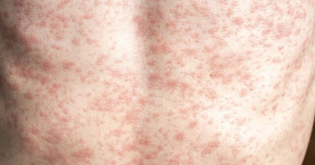 RFK Jr. Needs to 'Unconditionally' Advocate for Measles Vaccine, Lack of Vaccination Causing Deaths, Outbreak