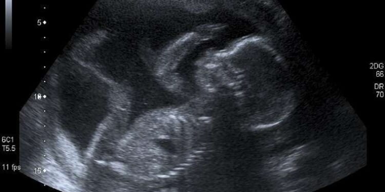 Health spending bill would keep ban on tax-funded abortion – Catholic World Report