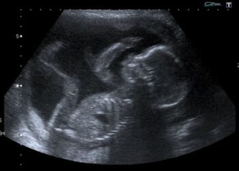 Only 37% of Americans identify as pro-life, but 67% want limits on abortion – Catholic World Report