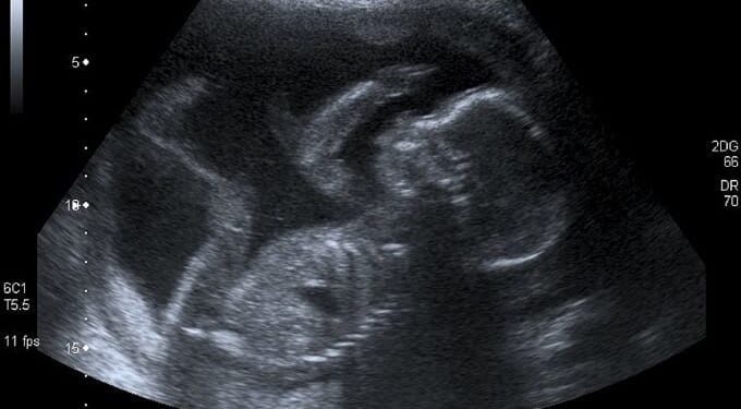 Only 37% of Americans identify as pro-life, but 67% want limits on abortion – Catholic World Report