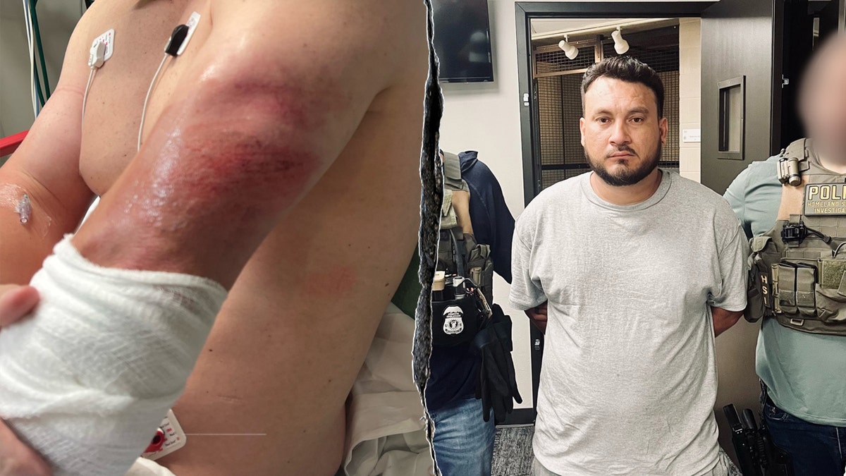 Scraped arm of ICE agent side by side with Honduran national in custody